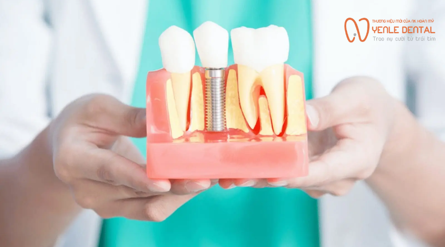 ưu điểm trồng răng Implant